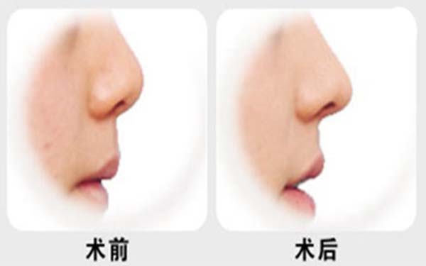 自体脂肪<a href=http://www.mx185.com/listinfo-737-0.html target=_blank class=infotextkey>隆鼻</a>是长期的吗