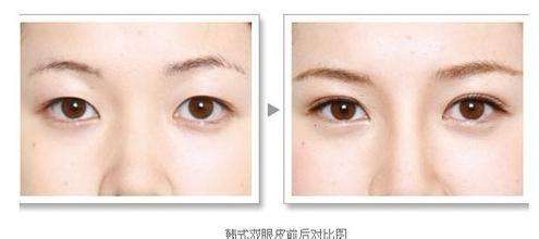 怎么变成<a href=http://www.mx185.com/listinfo-724-0.html target=_blank class=infotextkey>双眼皮</a>