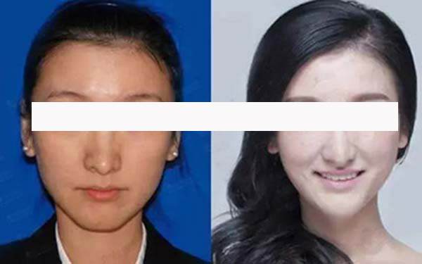 20岁发际线后移怎么办