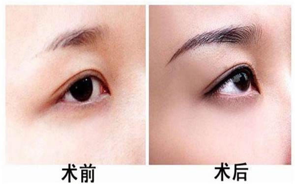 种植眉毛的适应人群及禁忌症