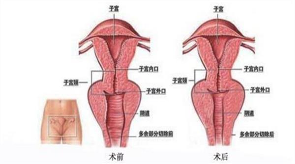 激光缩阴可以保持多久