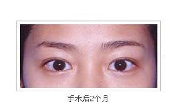 埋线法重睑术的手术过程
