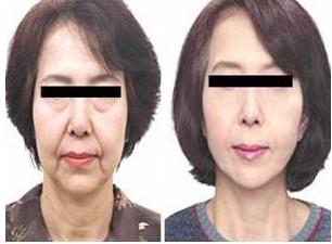 脸部皮肤松驰怎么办