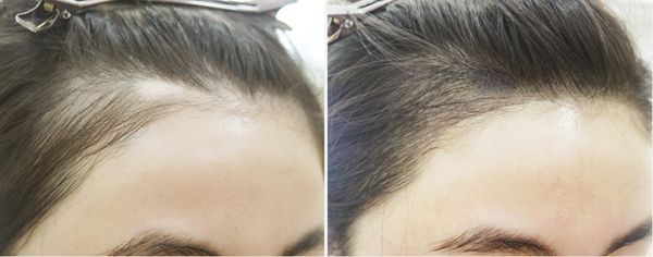 发际线种植术价格