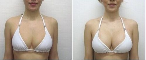乳房过大会影响身体健康吗