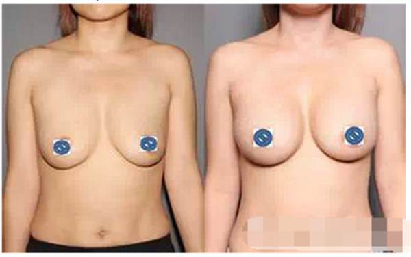 乳房下垂的原因是什么