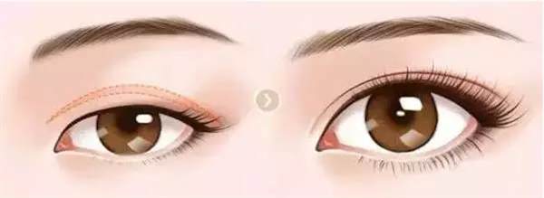 <a href=http://www.mx185.com/listinfo-717-0.html target=_blank class=infotextkey>上睑下垂矫正</a>原理