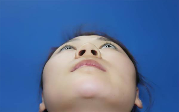 膨体<a href=http://www.mx185.com/listinfo-737-0.html target=_blank class=infotextkey>隆鼻</a>术前术后的注意事项