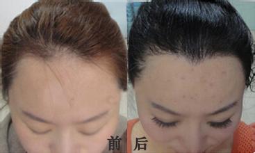 美人尖种植价格