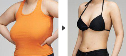 上海乳房缩小整形手术的效果如何