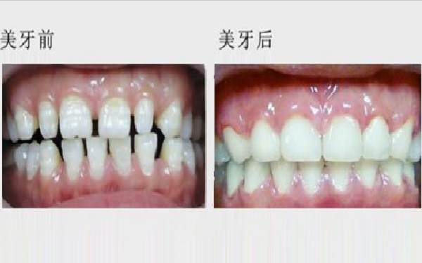 美容冠前后对比