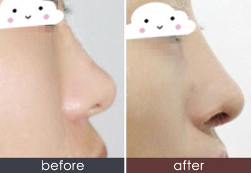 南京注射<a href=http://www.mx185.com/listinfo-737-0.html target=_blank class=infotextkey>隆鼻</a>价钱