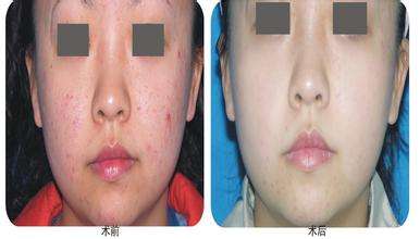 上海激光治疗蜘蛛痣价格是多少