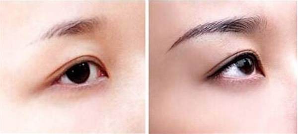 <a href=http://www.mx185.com/listinfo-714-0.html target=_blank class=infotextkey>纹眼线</a>几天掉痂