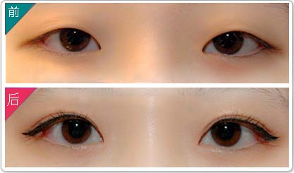 成都三点<a href=http://www.mx185.com/listinfo-724-0.html target=_blank class=infotextkey>双眼皮</a>价格是多少