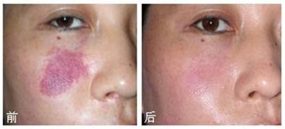 激光治疗蜘蛛痣优点有哪些