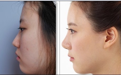 上海膨体<a href=http://www.mx185.com/listinfo-737-0.html target=_blank class=infotextkey>隆鼻</a>手术的优点有哪些