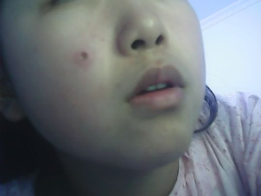 手术<a href=http://www.mx185.com/listinfo-767-0.html target=_blank class=infotextkey>祛痣</a>前应该注意什么呢