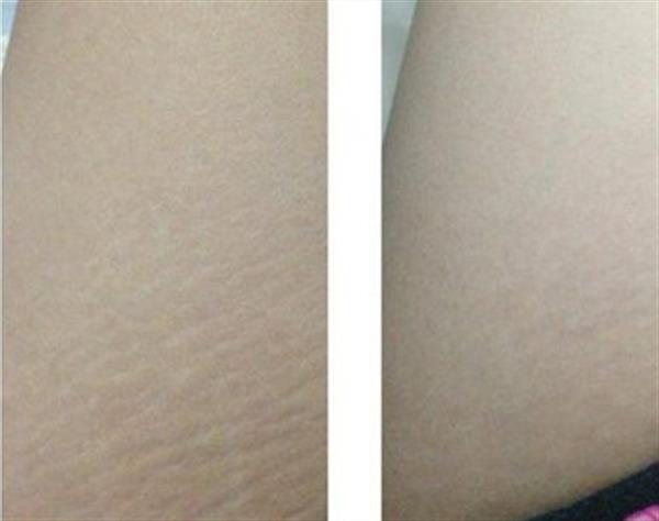 青春期的肥胖纹能去掉吗