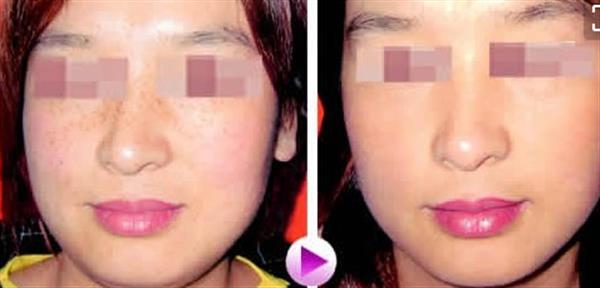治疗雀斑方法知多少