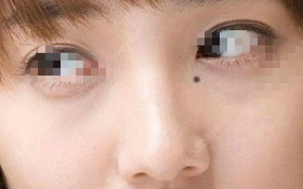 去痣后会留疤痕吗？