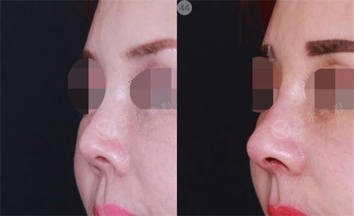 上海<a href=http://www.mx185.com/listinfo-737-0.html target=_blank class=infotextkey>隆鼻</a>修复手术价格