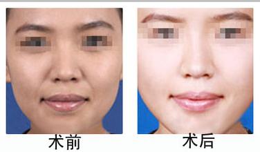 面部脂肪填充怎么样