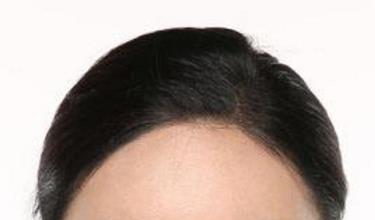 发际线<a href=http://www.mx185.com/listinfo-10-0.html target=_blank class=infotextkey>整形价格</a>