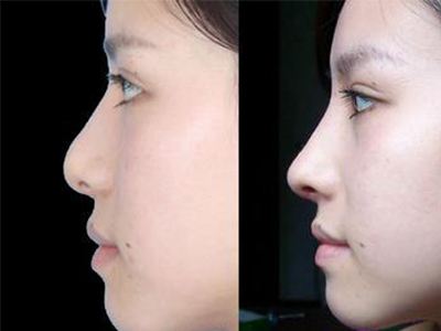 透明质酸注射<a href=http://www.mx185.com/listinfo-737-0.html target=_blank class=infotextkey>隆鼻</a>的价格多少