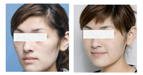  脸颊太瘦凹进去图片