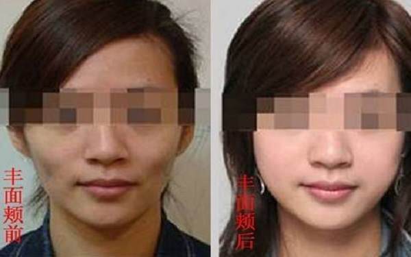 丰面颊需要多少钱