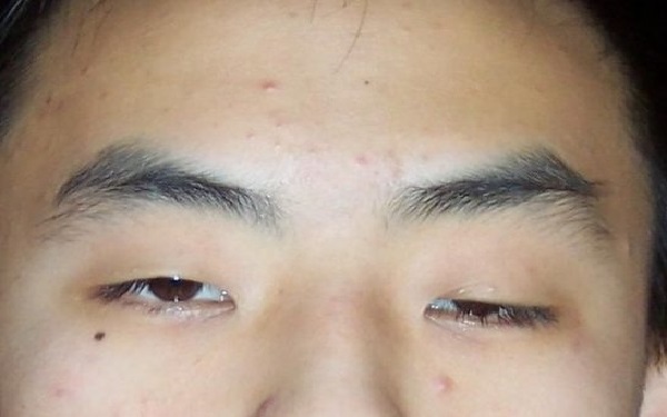 眼睑下垂矫正术费用