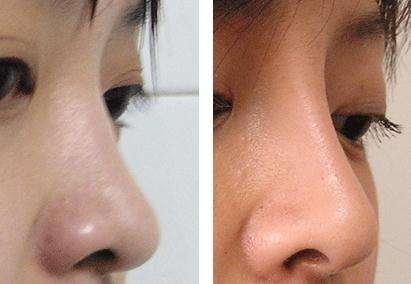 <a href=http://www.mx185.com/listinfo-734-0.html target=_blank class=infotextkey>爱贝芙</a>注射<a href=http://www.mx185.com/listinfo-737-0.html target=_blank class=infotextkey>隆鼻</a>是否安全