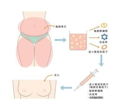 注射<a href=http://www.mx185.com/listinfo-618-0.html target=_blank class=infotextkey>隆胸</a>价格