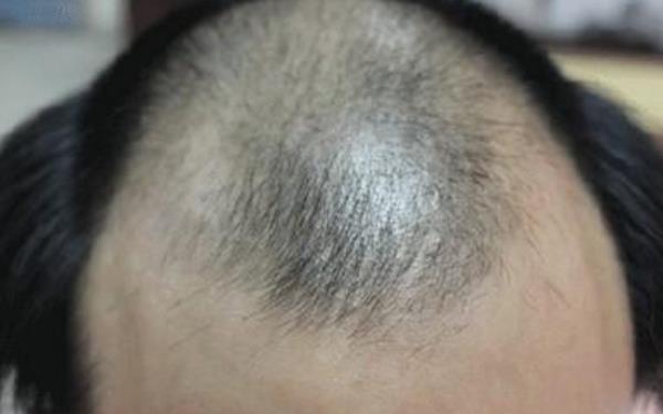 重庆哪家治脱发医院较好