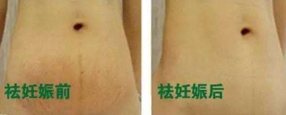 怎样有效去除妊娠纹