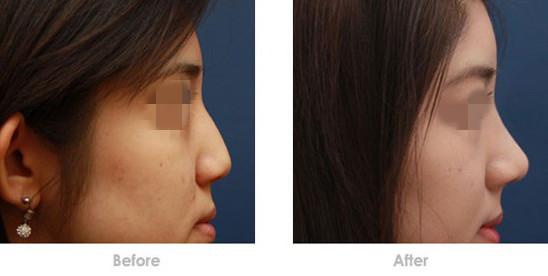 注射<a href=http://www.mx185.com/listinfo-737-0.html target=_blank class=infotextkey>隆鼻</a>为什么受到人们的欢迎