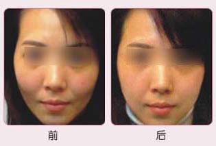 高颧骨整形大概多少钱