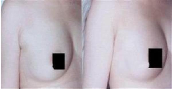 副乳切除术对腋臭有影响吗