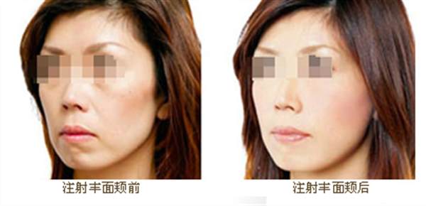 脸部脂肪填充多少钱