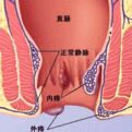  痔疮手术疼么