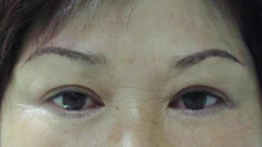 <a href=http://www.mx185.com/listinfo-655-0.html target=_blank class=infotextkey>切眉</a>一年后疤痕怎么消除