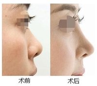 硅胶<a href=http://www.mx185.com/listinfo-737-0.html target=_blank class=infotextkey>隆鼻</a>可以长期吗