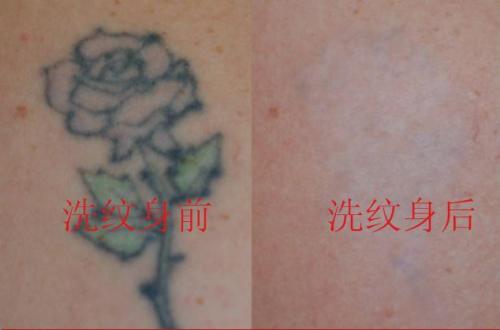 电灼去纹身优点