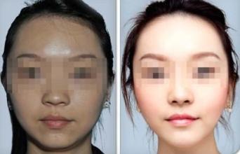 女人选择激光美白的效果怎样