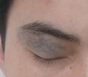 <a href=http://www.mx185.com/listinfo-799-0.html target=_blank class=infotextkey>去太田痣</a>多少钱?