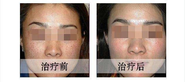 激光<a href=http://www.mx185.com/listinfo-786-0.html target=_blank class=infotextkey>去黄褐斑</a>多少钱？