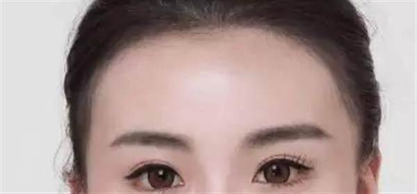 发际线后移能不能恢复