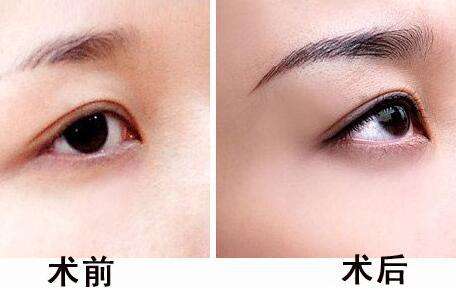 提眉手术费用贵不贵？