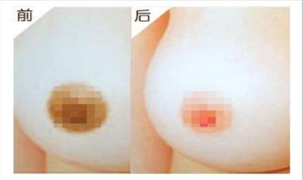 上海<a href=http://www.mx185.com/listinfo-616-0.html target=_blank class=infotextkey>乳晕整形</a>手术真的很快捷吗